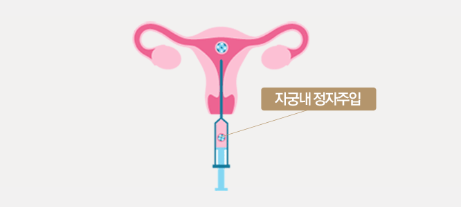 인공수정 방법